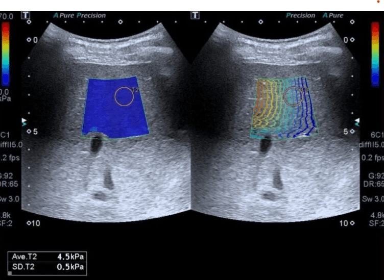 Side-by-side liver ultrasound elastography showing a color-coded stiffness map and wave propagation lines.